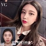 Before and after revision rhinoplasty results at VG Plastic Surgery, nose reshaping outcome