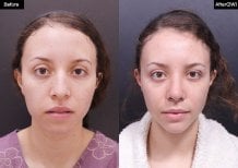 Revision rhinoplasty before and after results at VG Plastic Surgery, improved nose shape visible