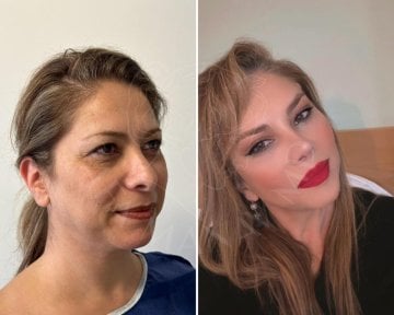 Before and after neck lift results at Dr. Safa Manav Clinic, visible facial rejuvenation