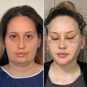 Before and after buccal fat extraction results at Dr. Safa Manav Clinic, facial contouring