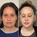 Before and after buccal fat extraction results at Dr. Safa Manav Clinic, facial contouring