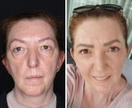 Before and after neck lift results at Dr. Safa Manav Clinic, visible facial rejuvenation