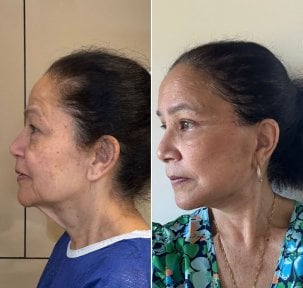 Before and after neck lift results at Dr. Safa Manav Clinic, visible neck and jawline tightening