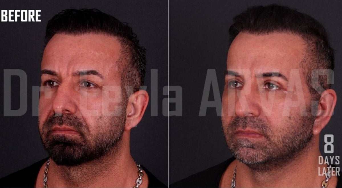 Результаты липофилинга лица до и после в Quartz Hospital, улучшение объема за 8 дней