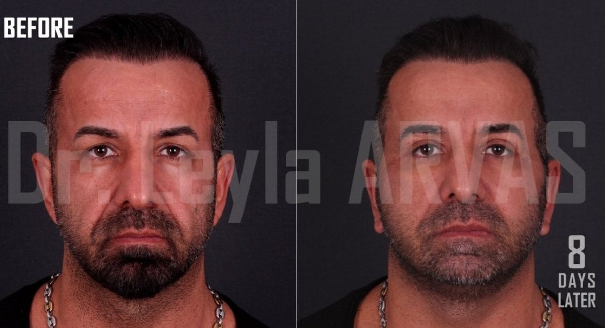 Результаты липофилинга лица до и после в Quartz Hospital, видимое омоложение за 8 дней