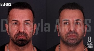 Результати ліпофілінгу обличчя до і після в Quartz Hospital, помітне омолодження за 8 днів