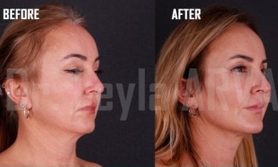 До та після ліпофілінгу обличчя в Quartz Hospital, помітне покращення контуру