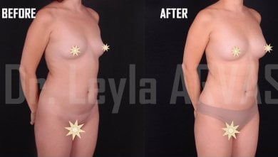Résultats avant/après augmentation mammaire par lipofilling à Quartz Hospital
