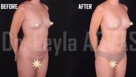 Résultats avant/après augmentation mammaire par lipofilling à Quartz Hospital