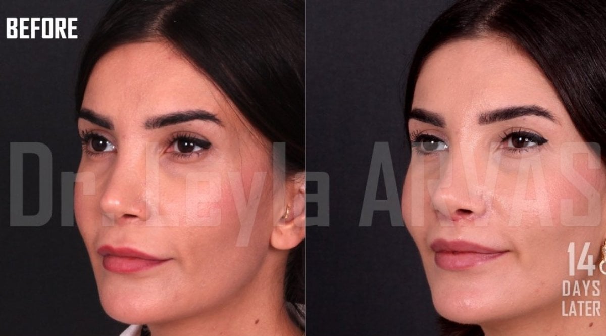 Результати до і після lip lift у Quartz Hospital, покращений контур верхньої губи