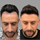 نتائج زراعة الشعر قبل وبعد في Quartz Hospital، خط شعر وكثافة محسّنة