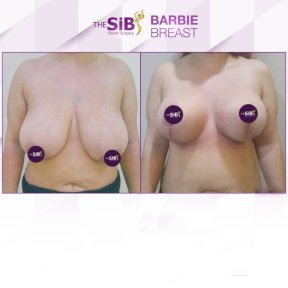 Efekty przed i po liftingu piersi w The SiB Plastic Surgery, poprawiony kształt piersi