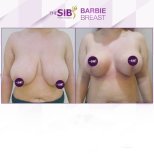 Efekty przed i po liftingu piersi w The SiB Plastic Surgery, poprawiony kształt piersi