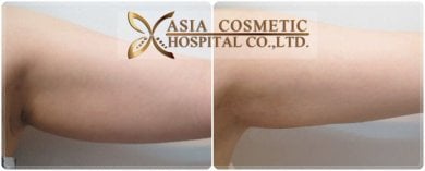 Before and after arm liposuction results at Asia Cosmetic Hospital, improved arm contour