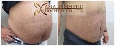 Before and after liposuction results at Asia Cosmetic Hospital, visible abdominal fat reduction