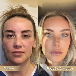 Before and after neck lift results at Dr. Safa Manav Clinic, visible facial rejuvenation