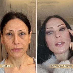 Before and after neck lift results at Dr. Safa Manav Clinic, visible rejuvenation after 3 months