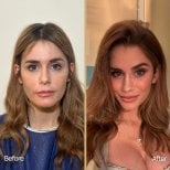 Before and after buccal fat extraction results at Dr. Safa Manav Clinic, slimmer cheeks