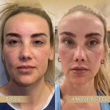 Buccal fat extraction before and after results at Dr. Safa Manav Clinic, slimmer face contour