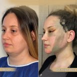 Before and after buccal fat extraction results at Dr. Safa Manav Clinic, slimmer face contour