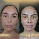 Before and after buccal fat extraction at Dr. Safa Manav Clinic, 5 days post-op results