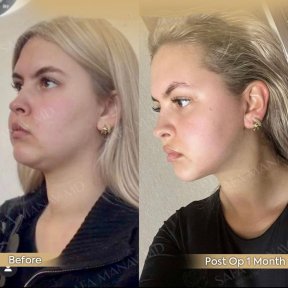 Buccal fat extraction before and after results at Dr. Safa Manav Clinic, slimmer cheeks