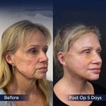 Before and after neck lift results at Dr. Safa Manav Clinic, visible jawline and neck improvement