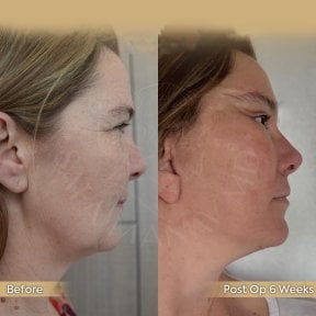 Before and after neck lift results at Dr. Safa Manav Clinic, visible jawline improvement