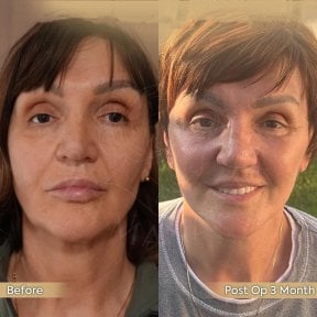 Before and after neck lift results at Dr. Safa Manav Clinic, visible facial rejuvenation