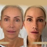 Before and after neck lift results at Dr. Safa Manav Clinic, visible facial rejuvenation