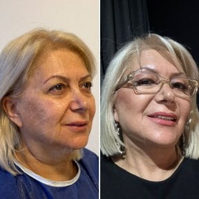 Before and after neck lift results at Dr. Safa Manav Clinic, visible facial rejuvenation