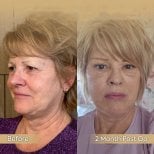 Before and after neck lift results at Dr. Safa Manav Clinic, visible skin tightening effect