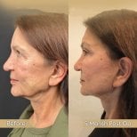 Before and after neck lift results at Dr. Safa Manav Clinic, visible jawline and neck improvement