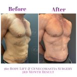 Vorher-nachher-Ergebnis 360 Bodylift und Gynäkomastie bei Db'est Clinic