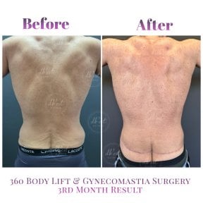 Vorher-nachher-Ergebnis 360 Bodylift und Gynäkomastie bei Db'est Clinic, 3 Monate