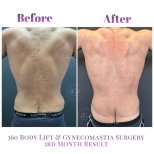 Vorher-nachher-Ergebnis 360 Bodylift und Gynäkomastie bei Db'est Clinic, 3 Monate