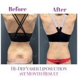 Before and after Hi-Def Vaser liposuction results at Db'est Clinic, 1 month body contour