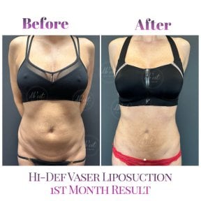 Before and after Vaser liposuction results at Db'est Clinic, visible body contour improvement