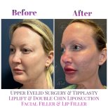 Before and after results of lip lift and facial fillers at Db'est Clinic, enhanced lip volume