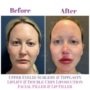 Before and after lip lift and facial filler results at Db'est Clinic, enhanced lips and contour