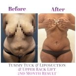 Vorher-nachher-Ergebnis Bauchdeckenstraffung, Liposuktion, Rückenlift bei Db'est Clinic, 2 Monate