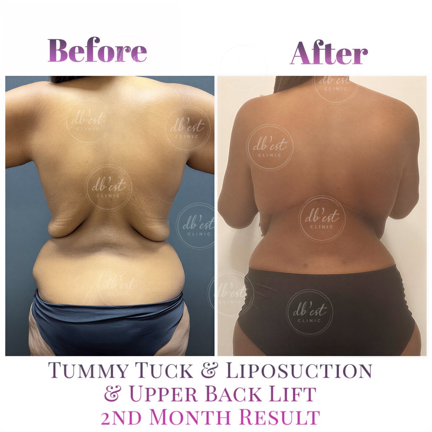 Antes y después de abdominoplastia, liposucción y lifting de espalda en Db'est Clinic, 2 meses