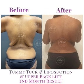 Vorher-nachher Bauchdeckenstraffung, Liposuktion, Rückenlifting bei Db'est Clinic, 2 Monate