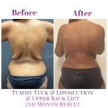 Vorher-nachher Bauchdeckenstraffung, Liposuktion, Rückenlifting bei Db'est Clinic, 2 Monate