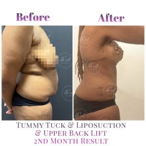 Vorher-nachher-Ergebnis Bauchdeckenstraffung, Liposuktion, Rückenlifting bei Db'est Clinic, 2 Monate