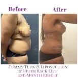 Vorher-nachher-Ergebnis Bauchdeckenstraffung, Liposuktion, Rückenlifting bei Db'est Clinic, 2 Monate