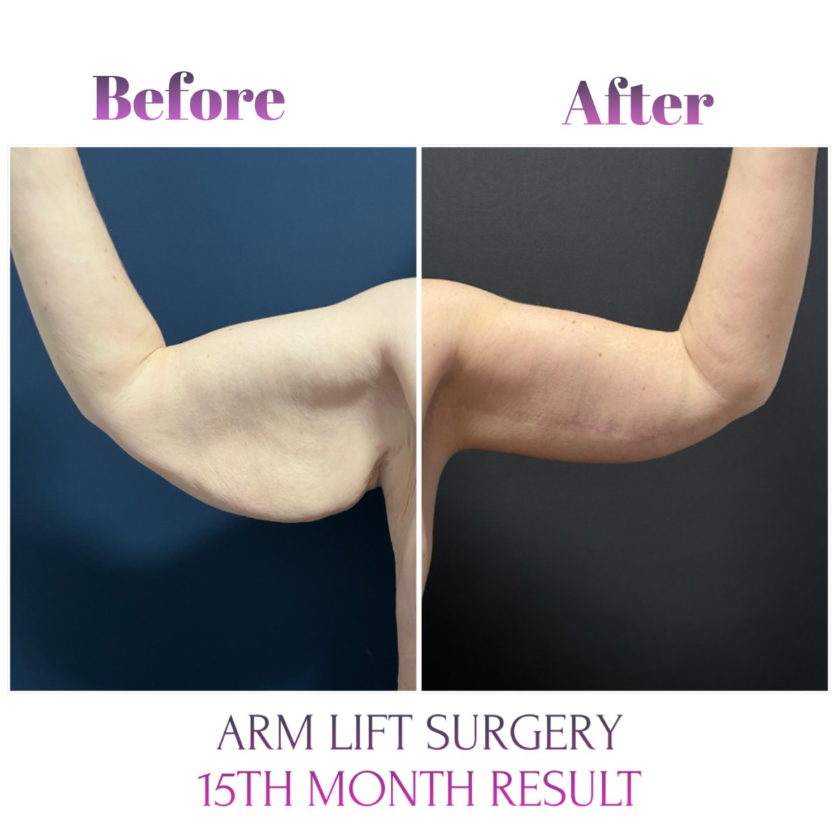 Resultados de lifting de brazos (braquioplastia) antes y después en Db'est Clinic, 15 meses