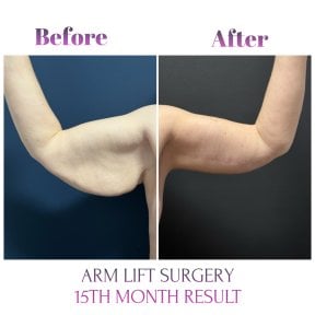 Vorher-nachher-Ergebnis der Oberarmstraffung (Brachioplastik) bei Db'est Clinic, 15 Monate