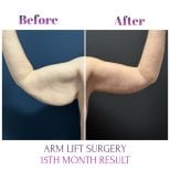 Vorher-nachher-Ergebnis der Oberarmstraffung (Brachioplastik) bei Db'est Clinic, 15 Monate