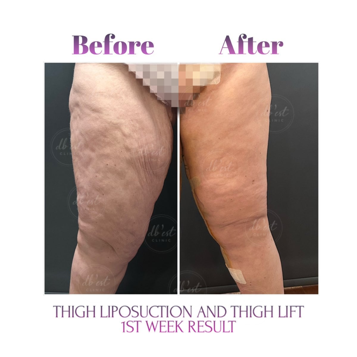 Resultados de lifting y liposucción de muslos antes y después en Db'est Clinic, 1ª semana